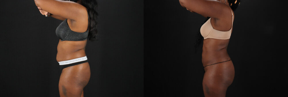 Brazilian Butt Lift case #5455