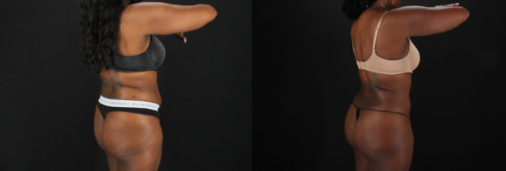 Brazilian Butt Lift case #5455