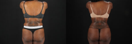 Brazilian Butt Lift case #5455