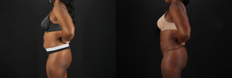 Brazilian Butt Lift case #5455