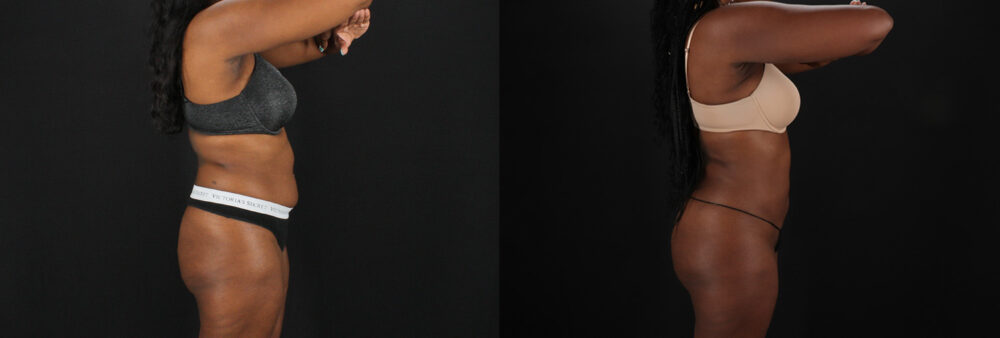 Brazilian Butt Lift case #5455