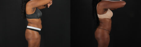 Brazilian Butt Lift case #5455