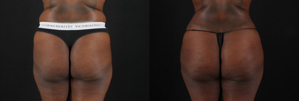 Brazilian Butt Lift case #5455