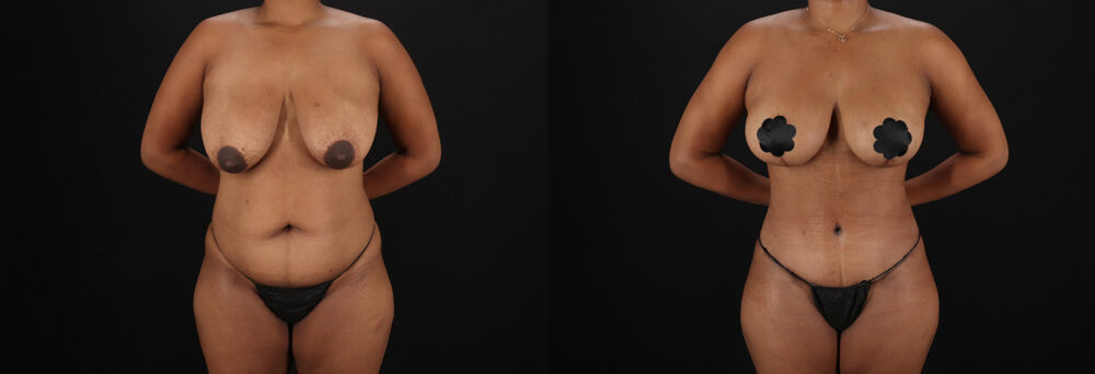 Tummy Tuck case #7619