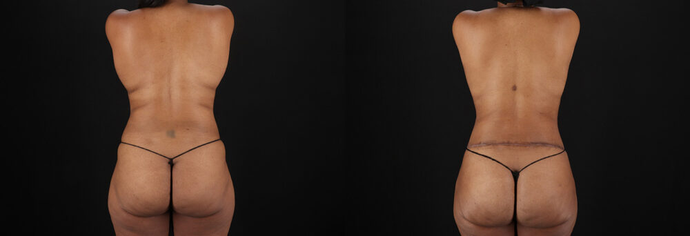 Tummy Tuck case #7619