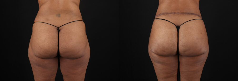 Tummy Tuck case #7619