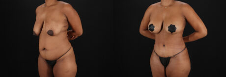 Tummy Tuck case #7619