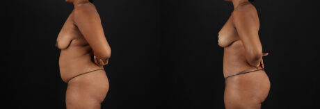 Tummy Tuck case #7619