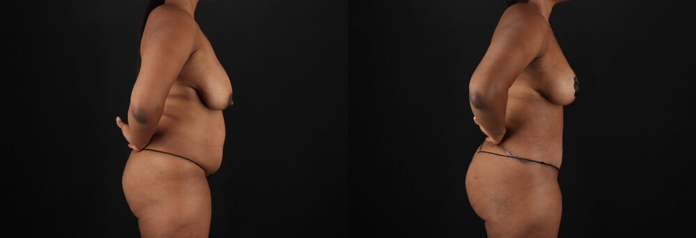 Tummy Tuck case #7619