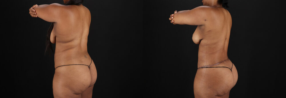 Tummy Tuck case #7619