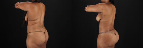 Tummy Tuck case #7619