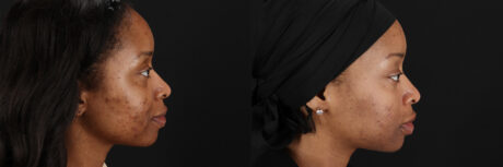 Cosmelan Chemical Peel case #5093