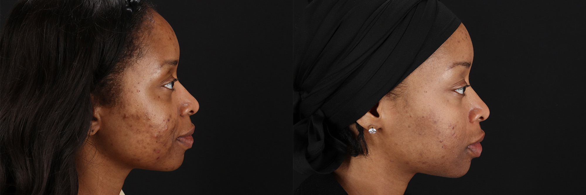 18143-27865-Chemical-Peel-before-and-after-photo-by-Dr.-Erika-A.-Sato-in-Houston-TX