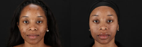 Cosmelan Chemical Peel case #5093