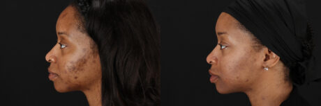 Cosmelan Chemical Peel case #5093