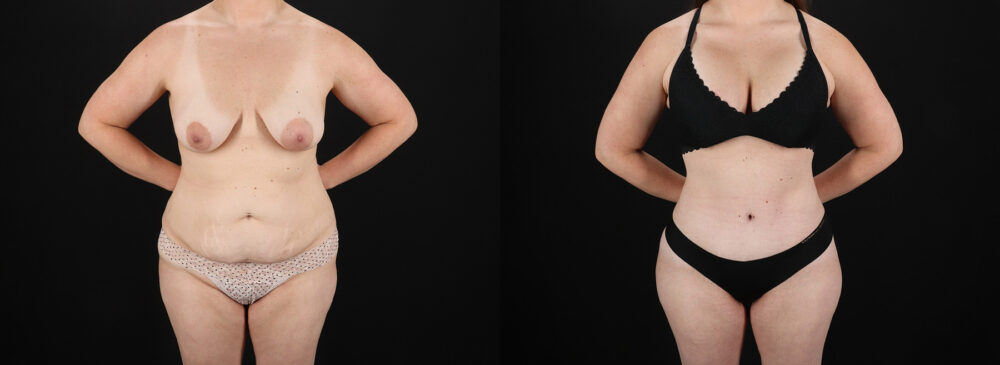 Mommy Makeover case #6686