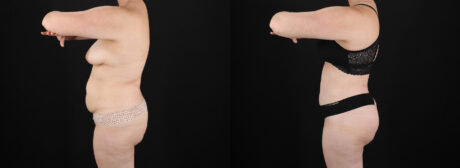 Mommy Makeover case #6686