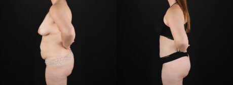 Mommy Makeover case #6686