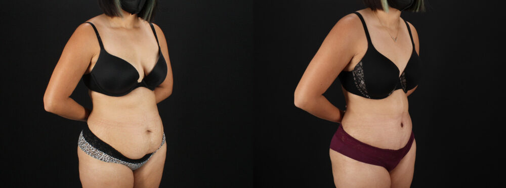 Tummy Tuck case #7617