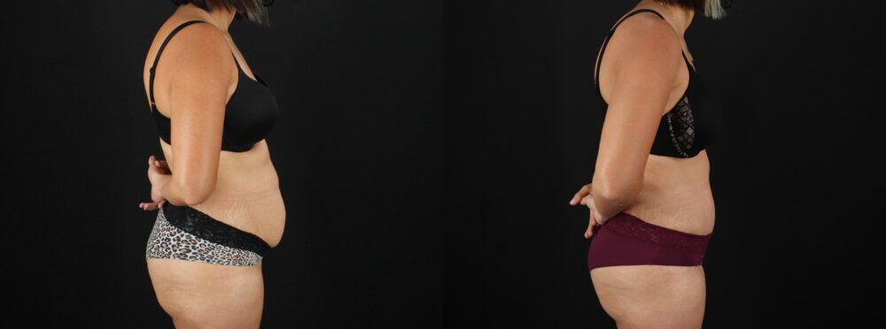 Tummy Tuck case #7617