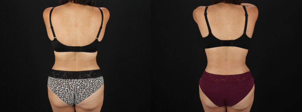 Tummy Tuck case #7617