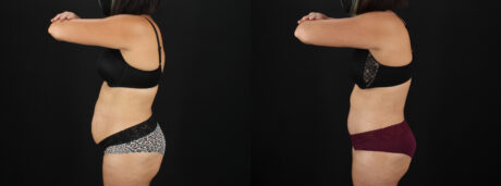 Tummy Tuck case #7617