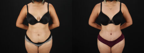 Tummy Tuck case #7617