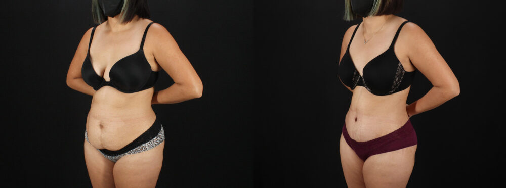 Tummy Tuck case #7617