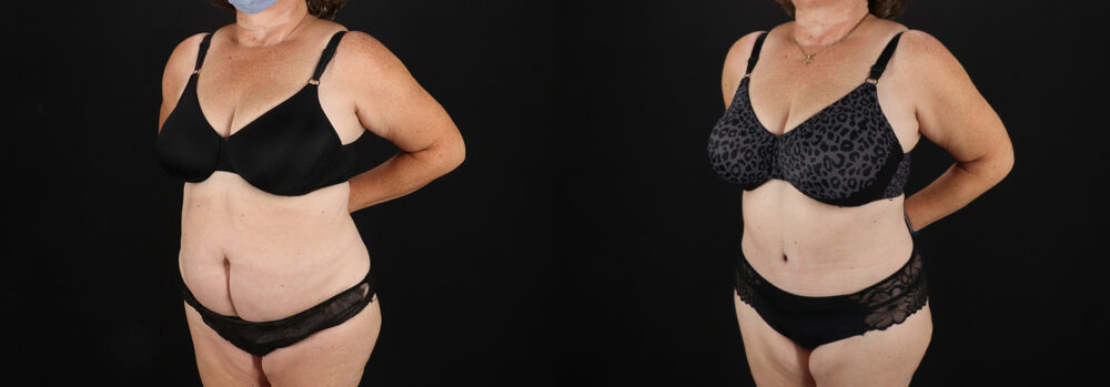 Tummy Tuck case #7624