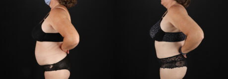 Tummy Tuck case #7624