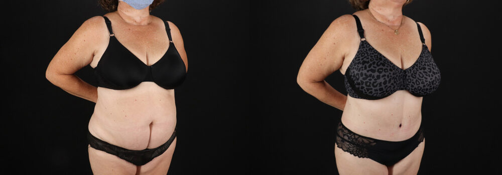 Tummy Tuck case #7624