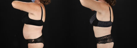 Tummy Tuck case #7624