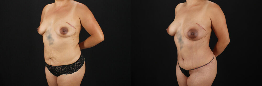 Mommy Makeover case #6685