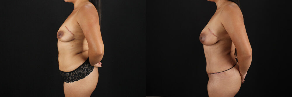 Mommy Makeover case #6685