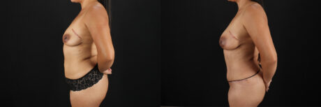 Mommy Makeover case #6685