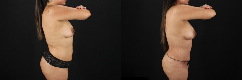 Mommy Makeover case #6685