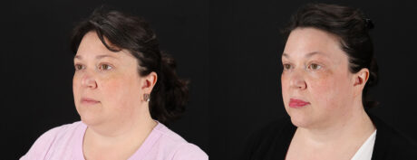 Profound RF Skin Tightening case #6907