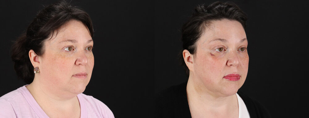 Profound RF Skin Tightening case #6907