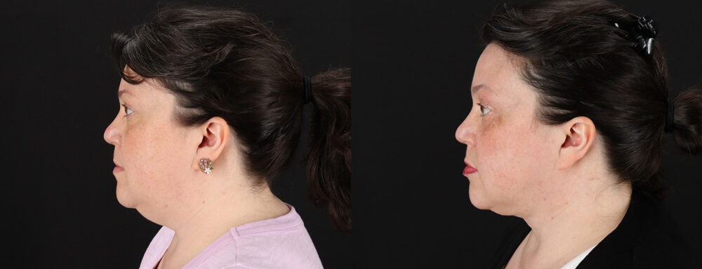 Profound RF Skin Tightening case #6907