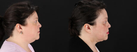 Profound RF Skin Tightening case #6907