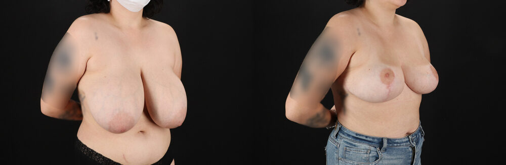 Breast Reduction case #8006