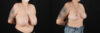 Breast Reduction case #8006 slider thumbnail