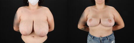 Breast Reduction case #8006