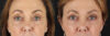 Blepharoplasty case #6889 slider thumbnail