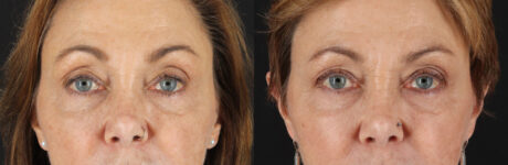 Blepharoplasty case #6889