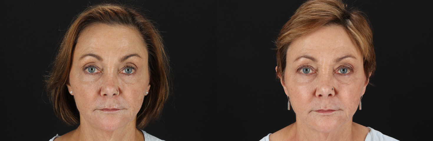 18649-66314-Blepharoplasty-before-and-after-photo-by-Dr.-Erika-A.-Sato-in-Houston-TX