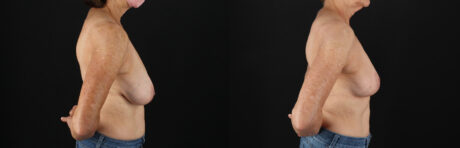 Breast Reduction case #8012