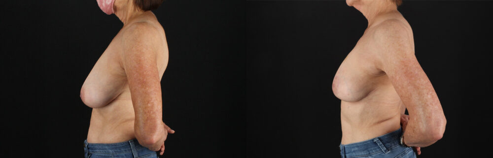 Breast Reduction case #8012