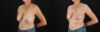 Breast Reduction case #8012 slider thumbnail