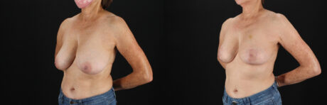 Breast Reduction case #8012